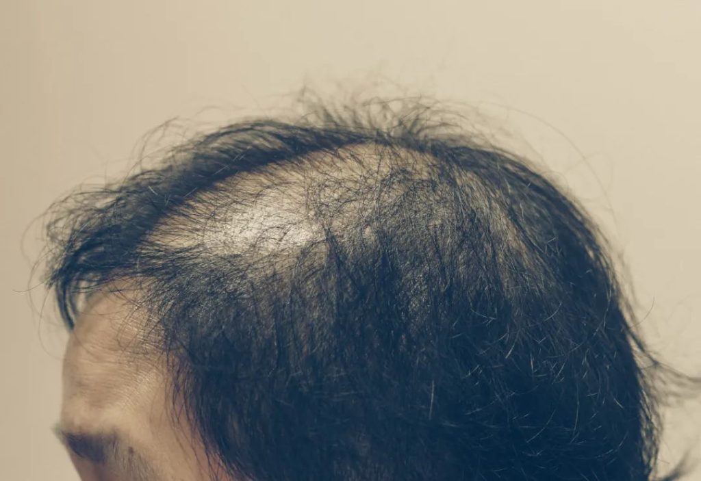 Dihydrotestosterone is the main culprit of male hair loss