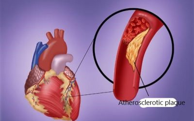 Rutgers University, USA: NMN reduces heart damage after myocardial infarction