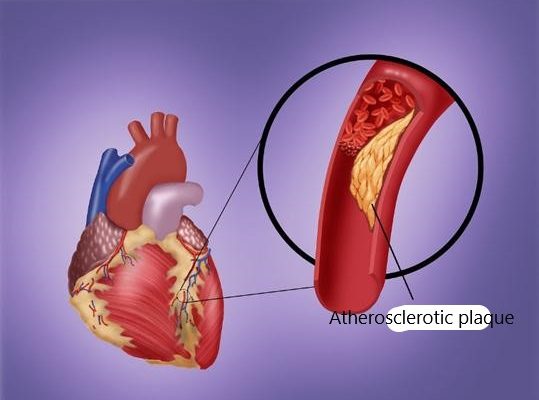 Rutgers University, USA: NMN reduces heart damage after myocardial infarction