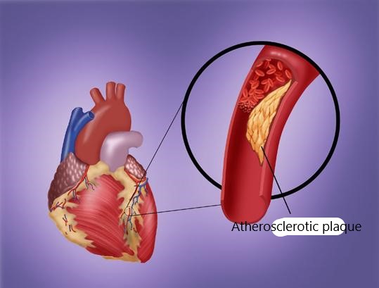 Figure 1 Atherosclerotic plaque is a common cause of coronary artery blockage, which can lead to ischemia of the heart and symptoms of heart attack