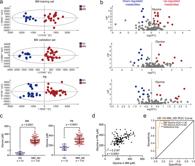 Blocking glycine utilization inhibits multiple myeloma progression by disrupting glutathione balance