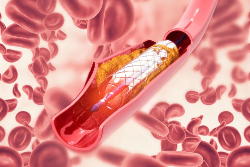 Efficacy and safety of citicoline in the treatment of mild vascular cognitive impairment